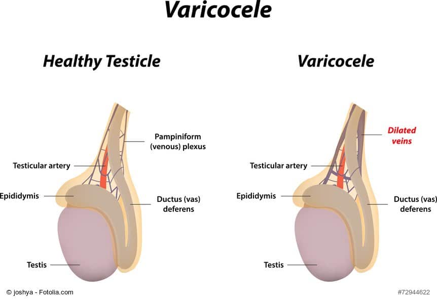 What is Varicocele Embolization?