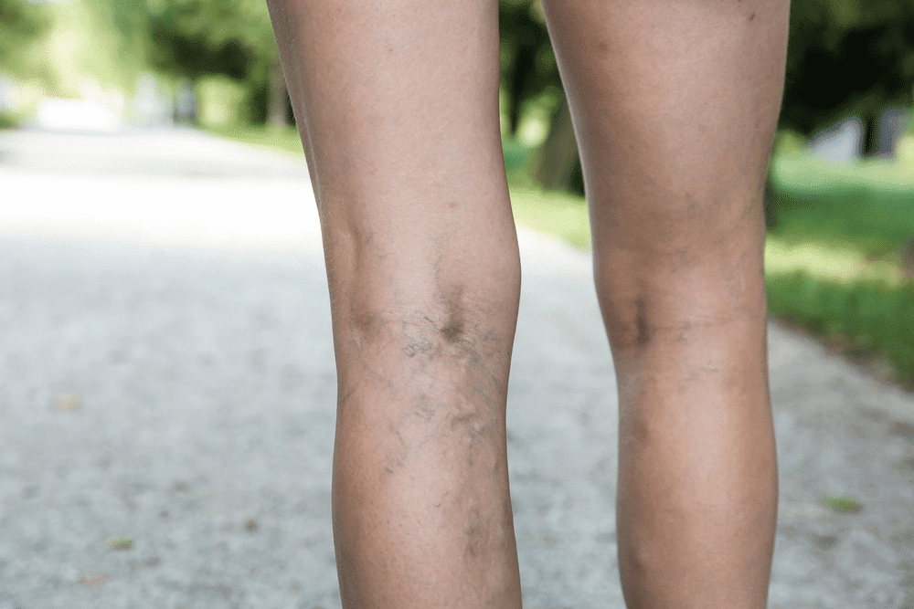 Does Sclerotherapy Last