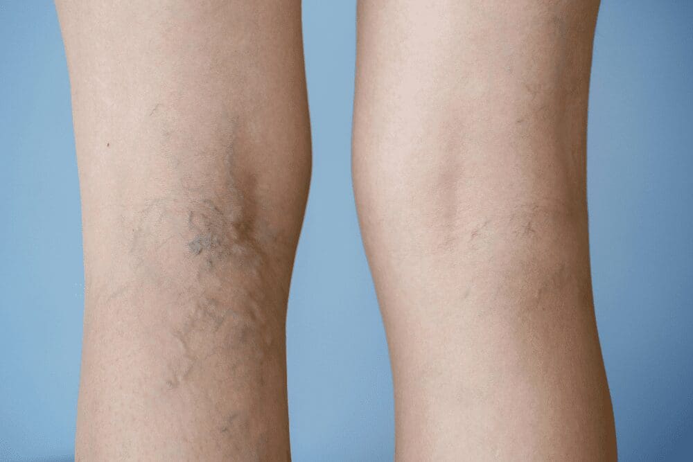 The Ultimate Guide to Vein Treatment Options - North Texas Vein
