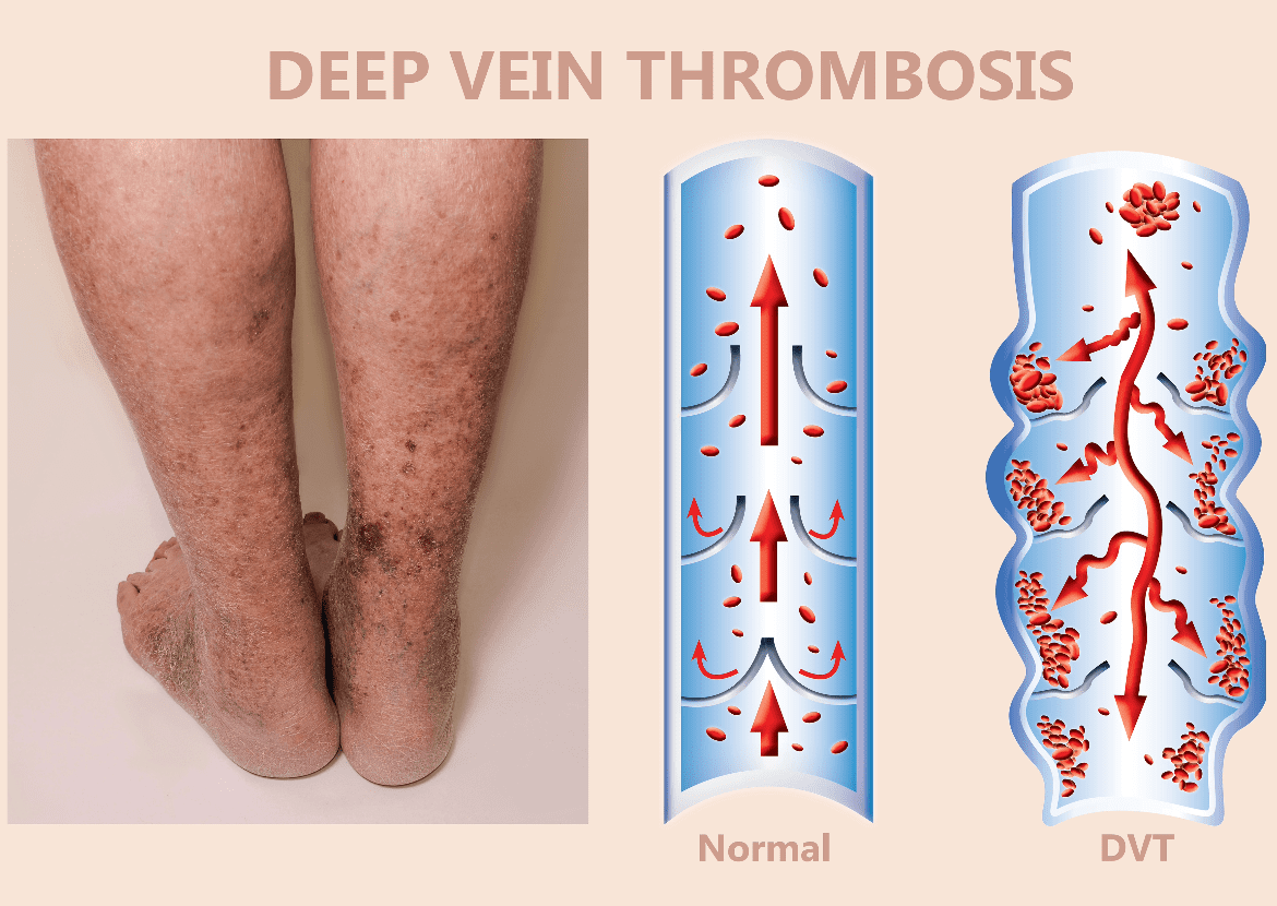 Compression stockings ineffective in treating Deep Vein Thrombosis